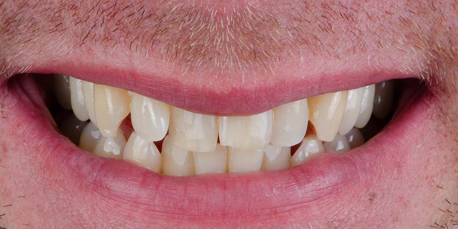 Before and after cosmetic dental treatment with ceramic veneers to improve teeth alignment shape and color