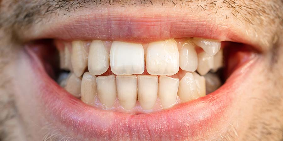 Close up teeth man. Before and after treatment teeth alignment, braces banner