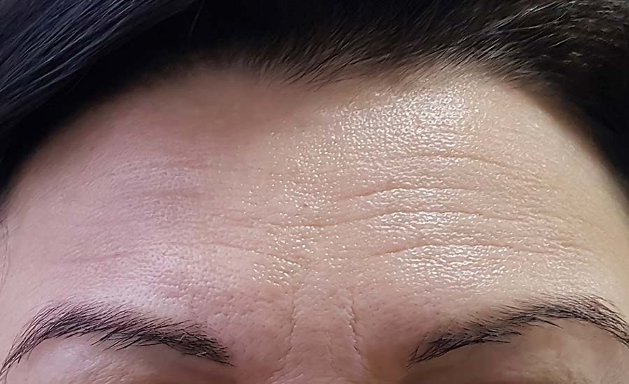 forehead women wrinkles before and after