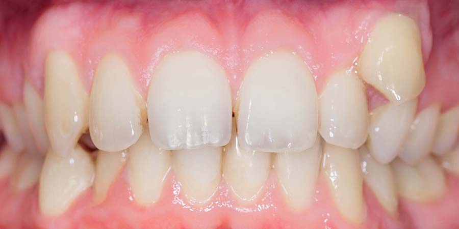 Complete smile makeover from crooked teeth to well aligned smile. Before after after using aligners invisalign or brackets