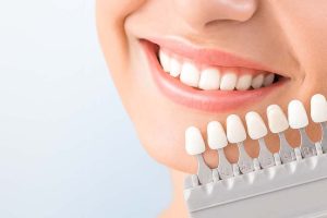 Beautiful smile and white teeth of a young woman. Matching the shades of the implants or the process of teeth whitening.