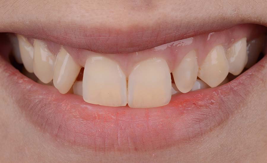 Before and after comparing of dental ceramic veneers treatment for space closing.